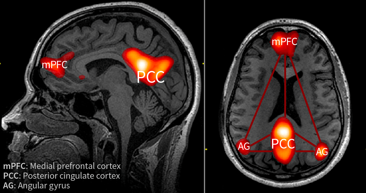 The brain's Default Mode Network (DMN) with medial prefrontal cortex (mPFC), posterior cingulate cortex (PCC) and the angular gyrus (AG)