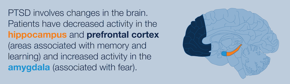 How PTSD affects hippocampus, prefrontal cortex and the amygdala